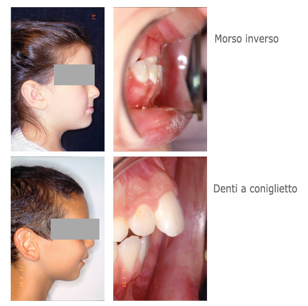 morso-inverso-denti-coniglietto